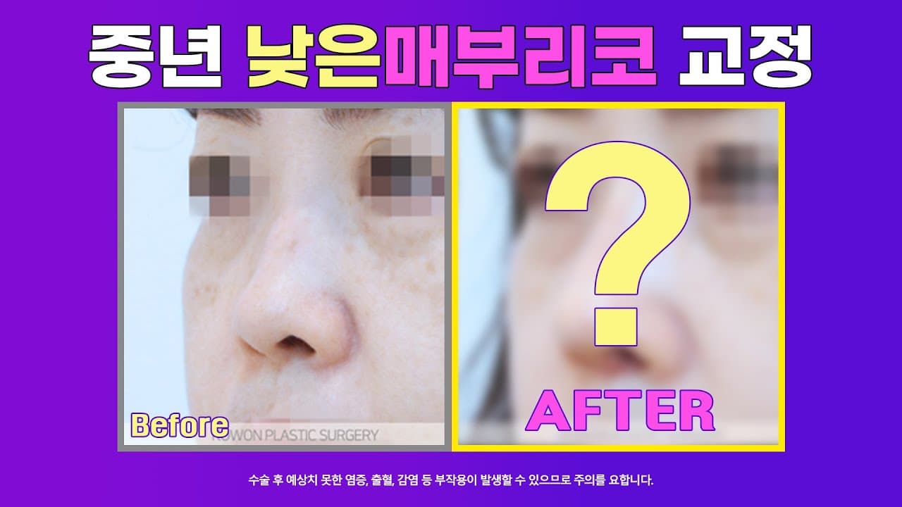 중년 코 첫수술 낮은 매부리코 교정 전 후