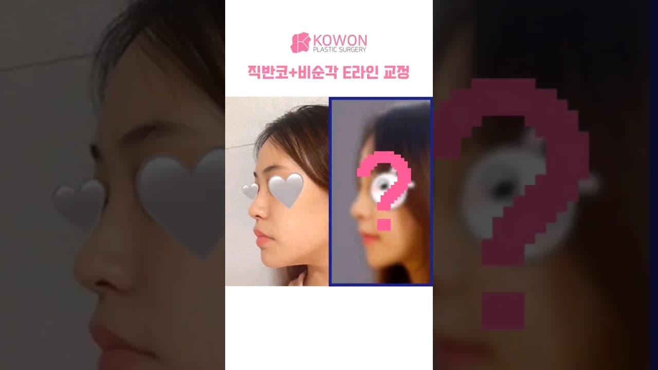🌈 코원 코 성형 후기 | 입체감있고 여성스러운 코를 원해요 (E 라인 비순각교정)