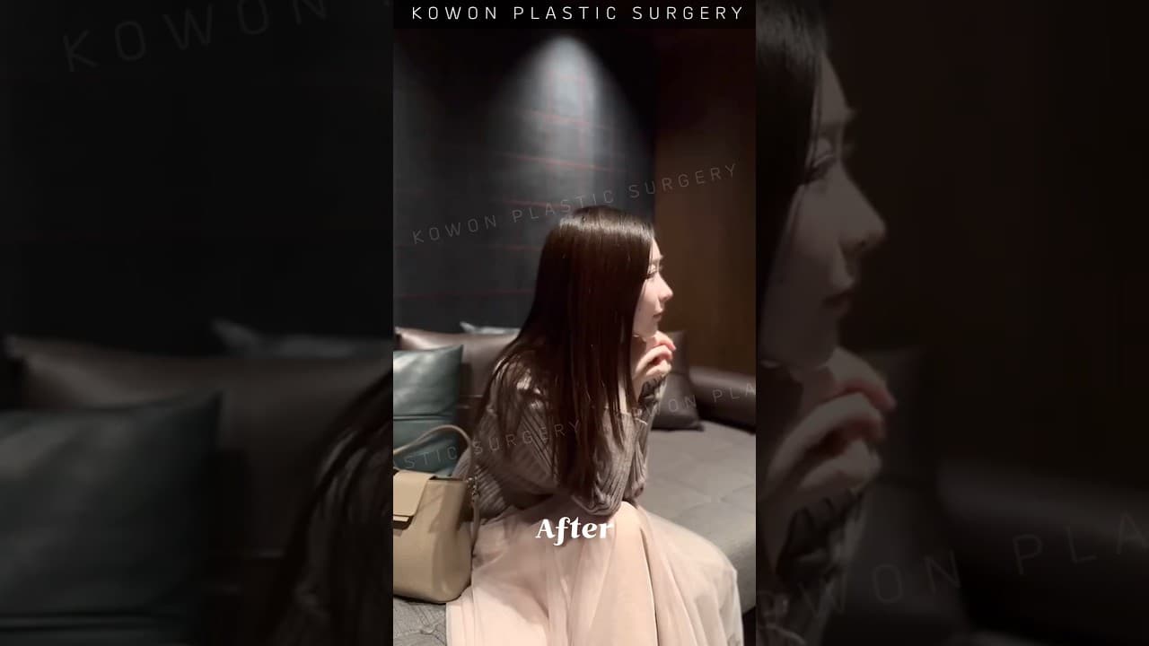 낮은코 자연스럽게 높아지기 #nosejob #낮은코수술 #코원성형외과