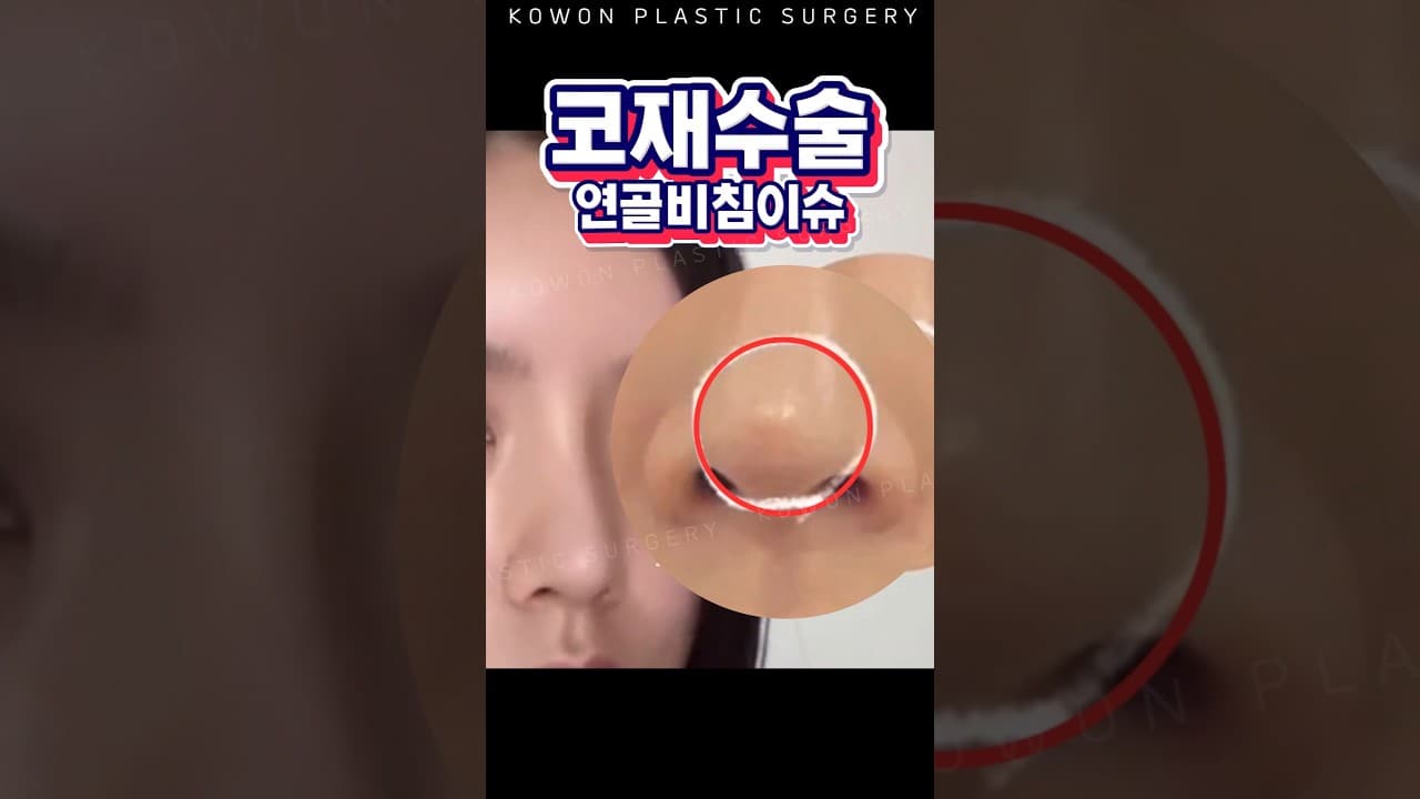 높은 코는 무조건 옳다? 코재수술한 이유_찐 후기