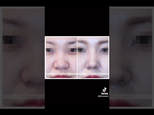 코원성형외과 코 성형 ★Before & After★_매부리코