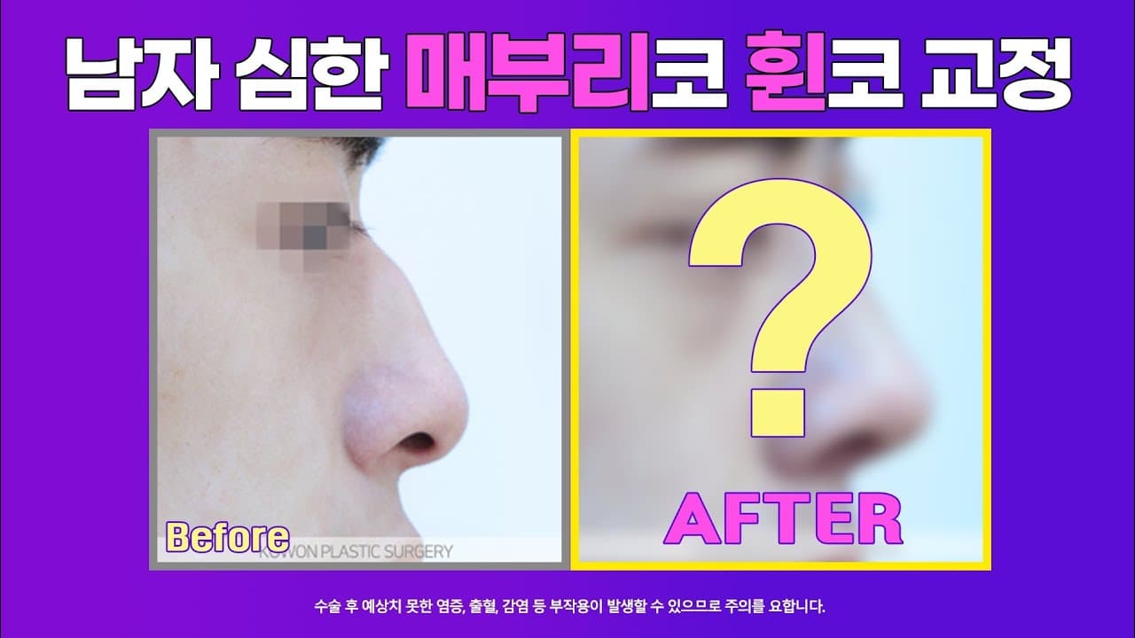 남자 매부리코 교정 전후사진 : 크고 휜 남자코 무보형물 매부리코 수술