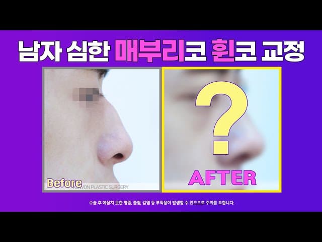 남자 매부리코 교정 전후사진 : 크고 휜 남자코 무보형물 매부리코 수술