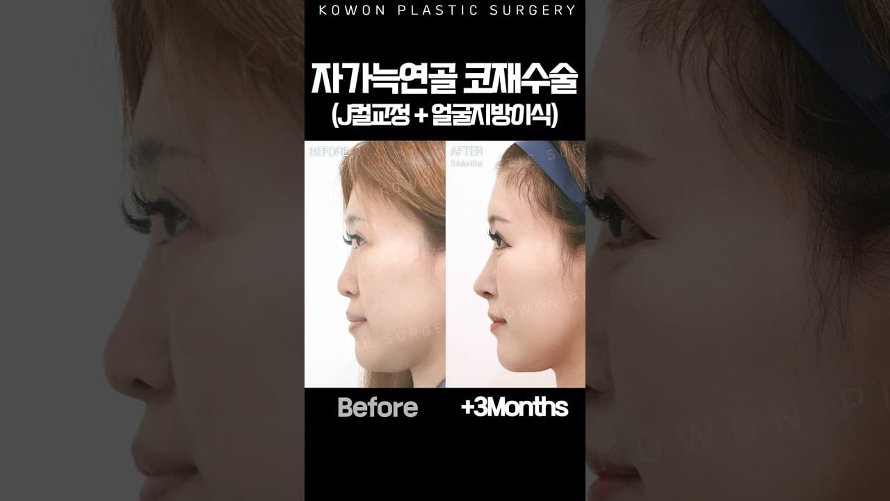 ✨ 코재수술 & 중안면부 함몰 개선 Before & After ✨