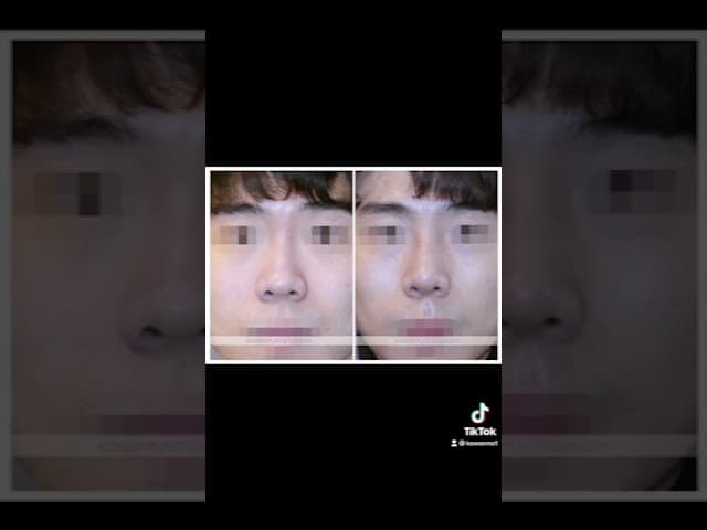 코원성형외과 코 성형 ★Before & After★_매부리코