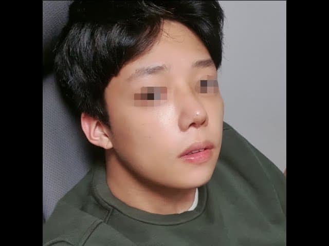 코원 성형외과 코 성형 ★Before & After★
