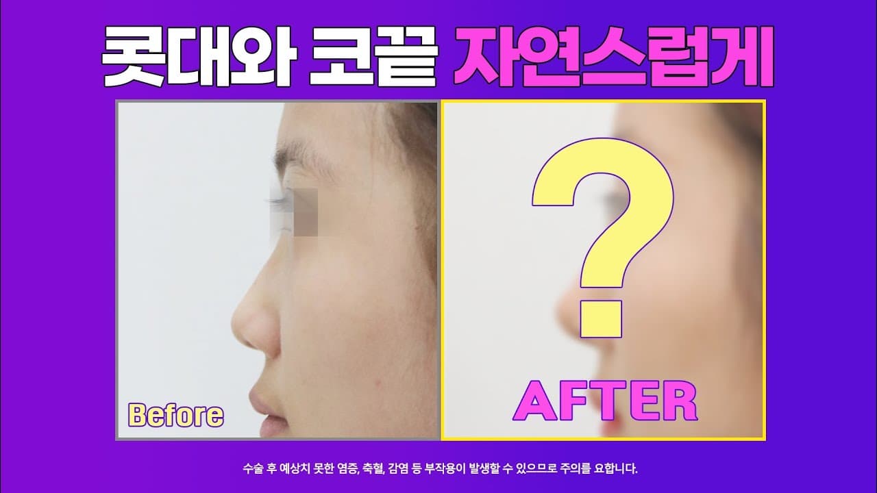 낮고 퍼진코 자연스럽게 교정될수있을까?
