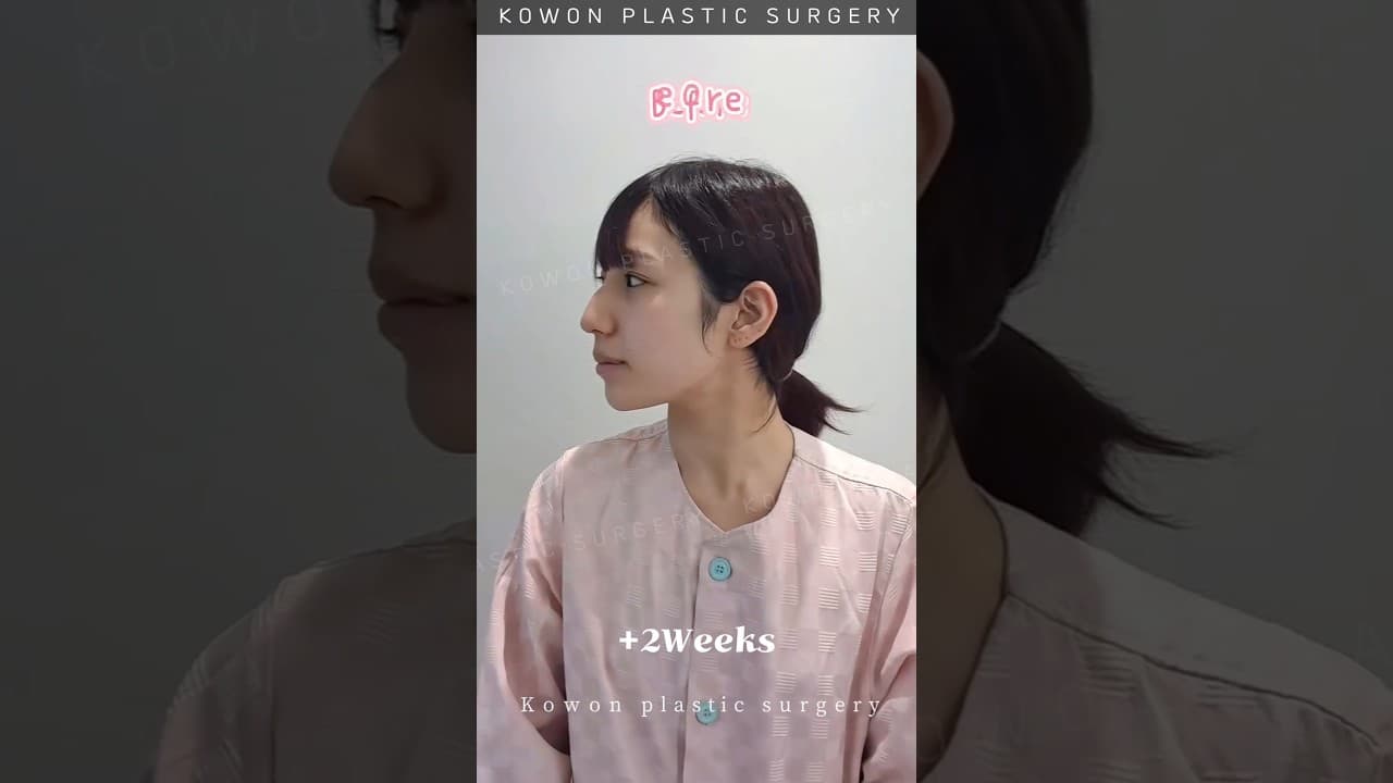 매부리코 고민이였는데... 교정했더니!
