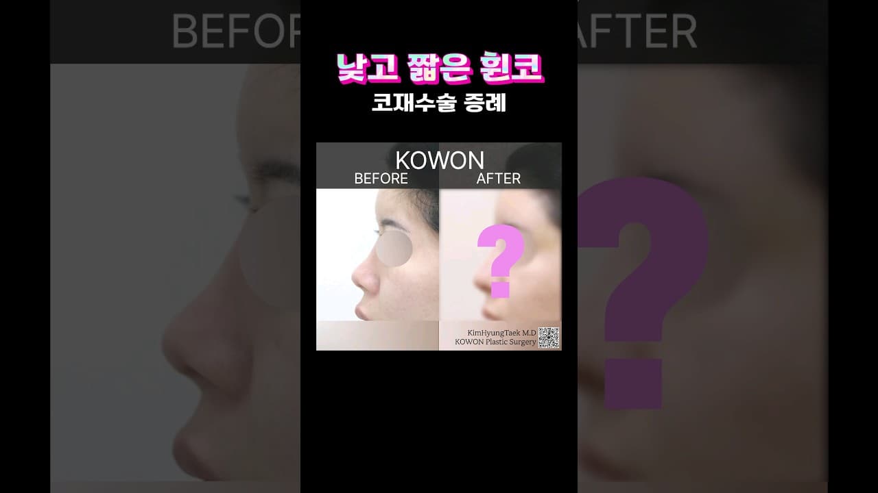 타원 코수술 후 휘고 들려지는 증상으로 코원에서 재코수술