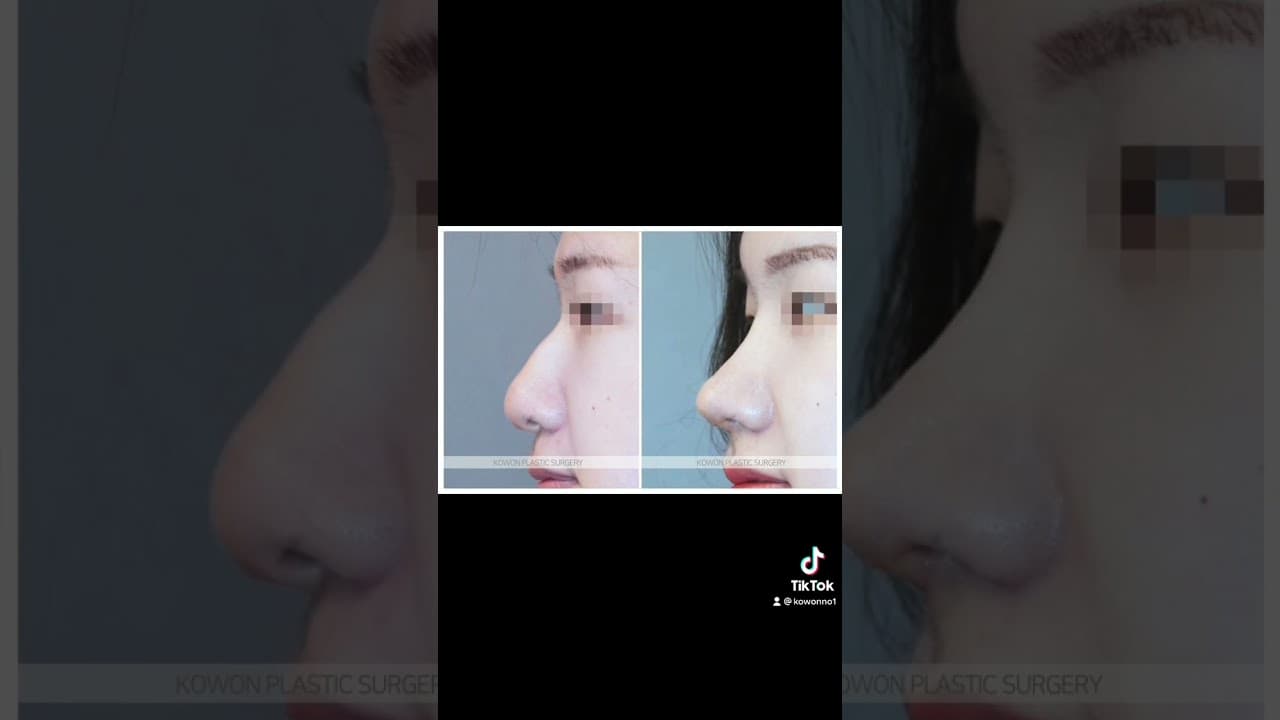 코원성형외과 코 성형 ★Before & After★_매부리코