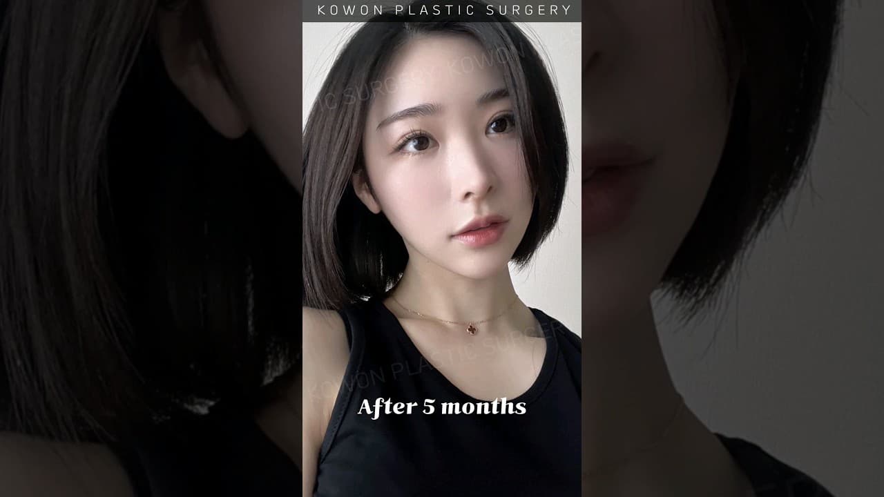 예쁘지만 낮은코 고민이였던 케이스 코원 코끝교정 후 너무예뻐