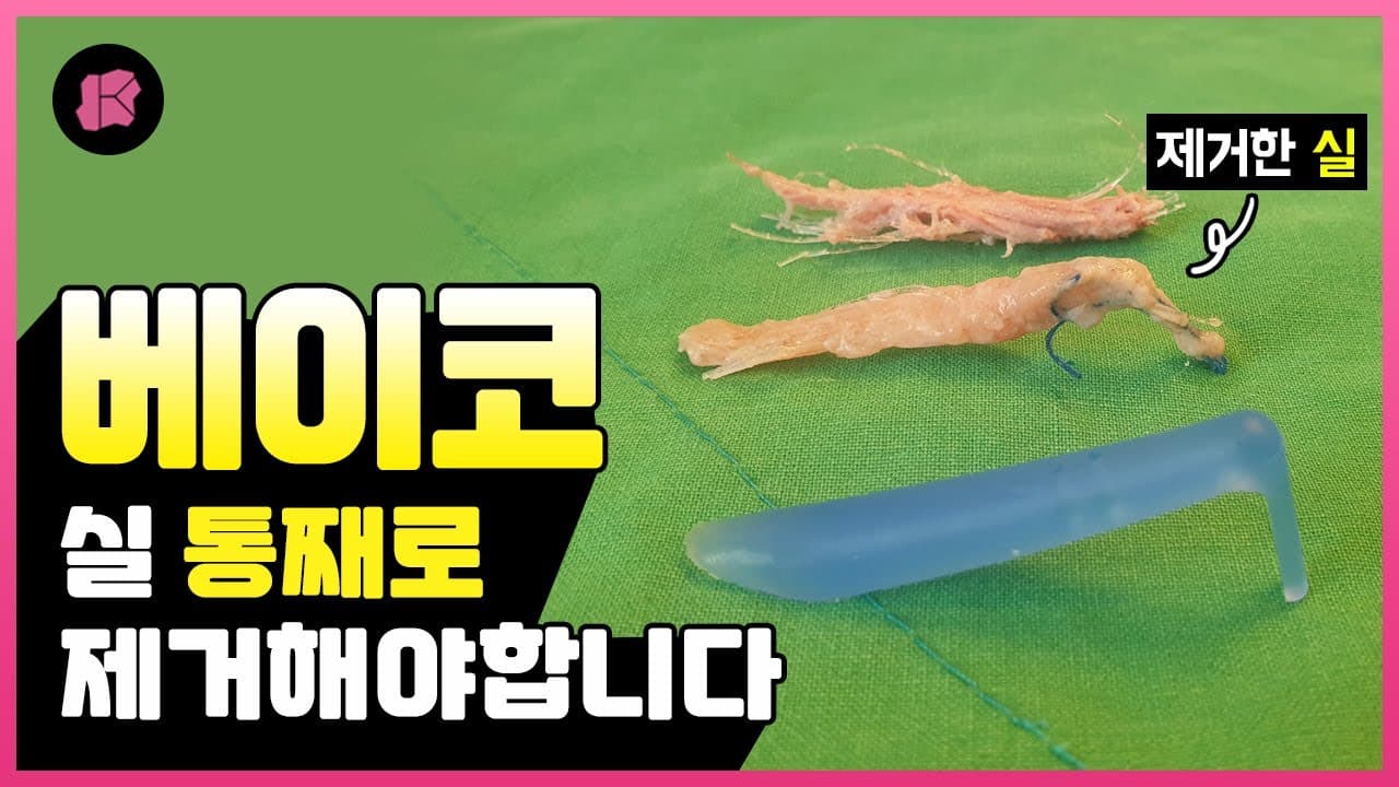 코성형 코시술 실 한꺼번에 제거하는 것이 좋은 이유? | 베이코, 하이코, 미스코