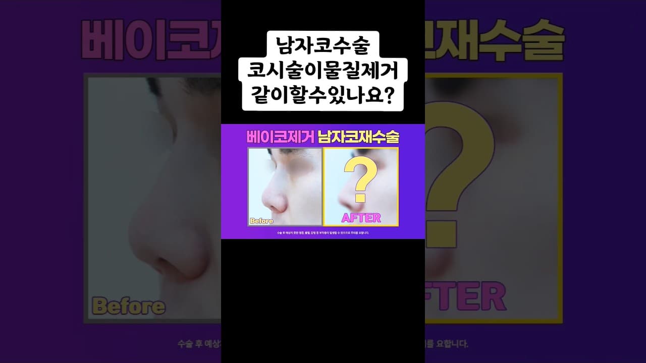 📌 남자 코재수술 Before & After