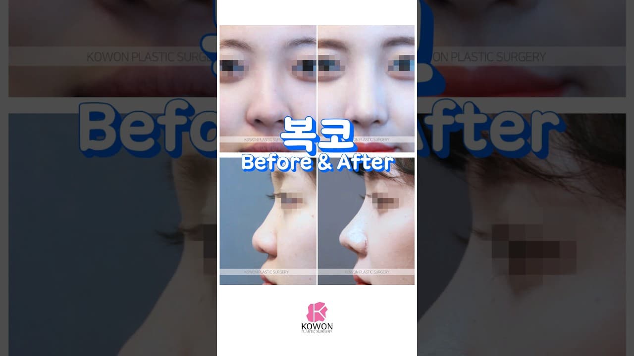 복코 들창코 퍼진코 교정 변화 같이 보기