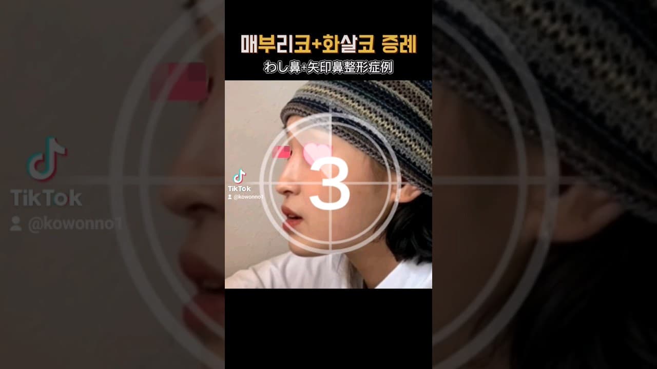 매부리코 코끝 수술: 자연스러운 변화로 더욱 매력적인 얼굴 완성하기