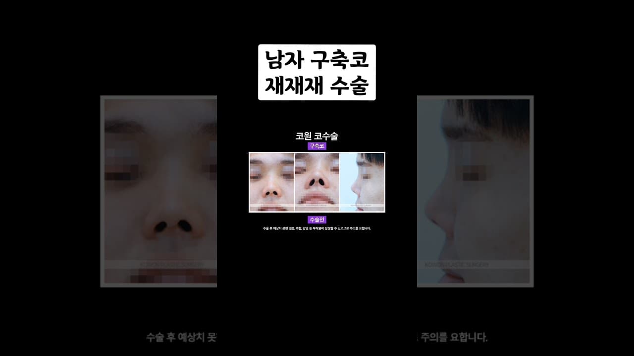 구축코 수술 후기 | 남자 구축코 재재재수술 자가늑연골 이용