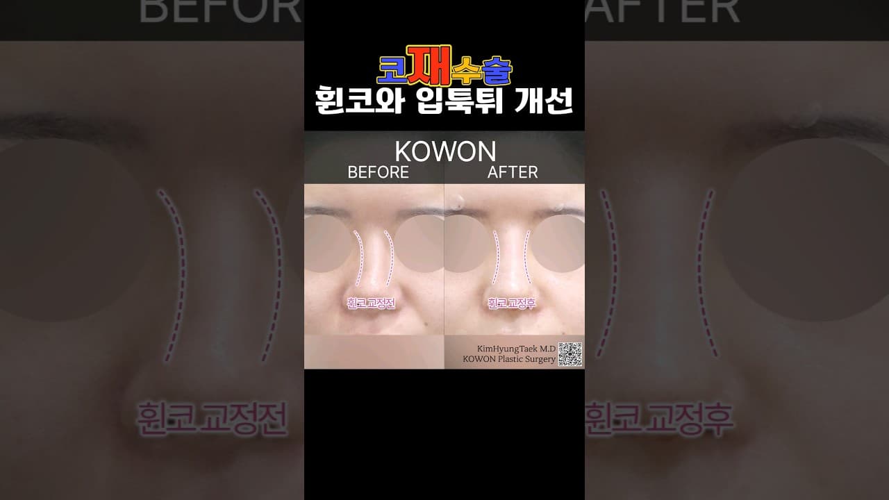 코재수술하고 휜코와 입툭튀 개선