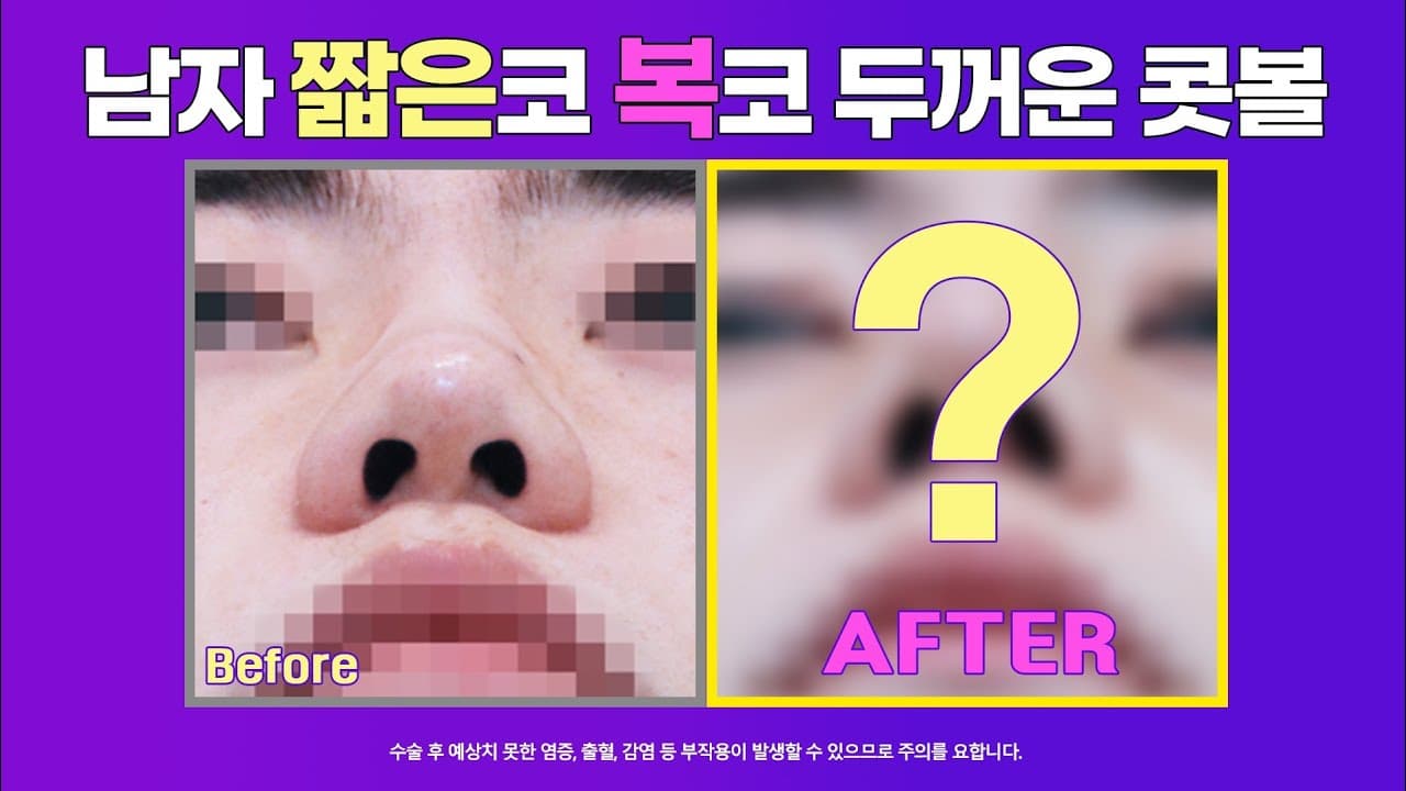 남자 짧은코 전후증례 : 남자 복코수술 두꺼운 피부의 코끝비중격연장