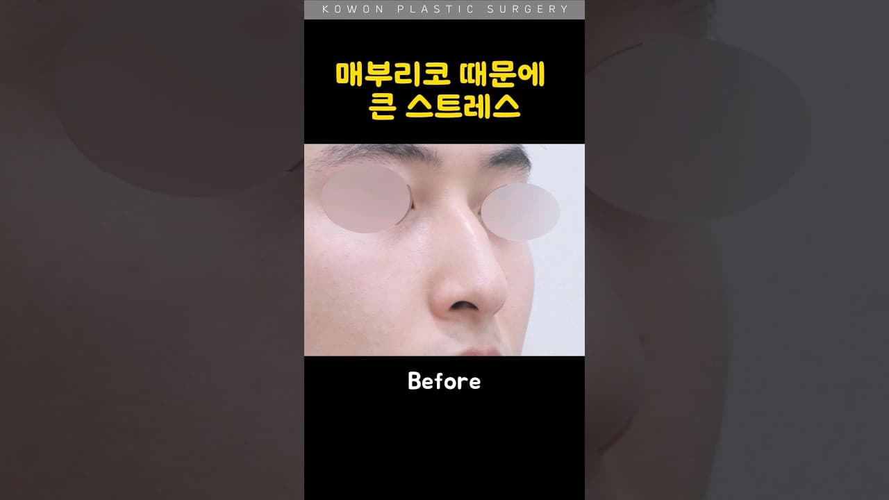 코원 남자 매부리코 교정 전 후