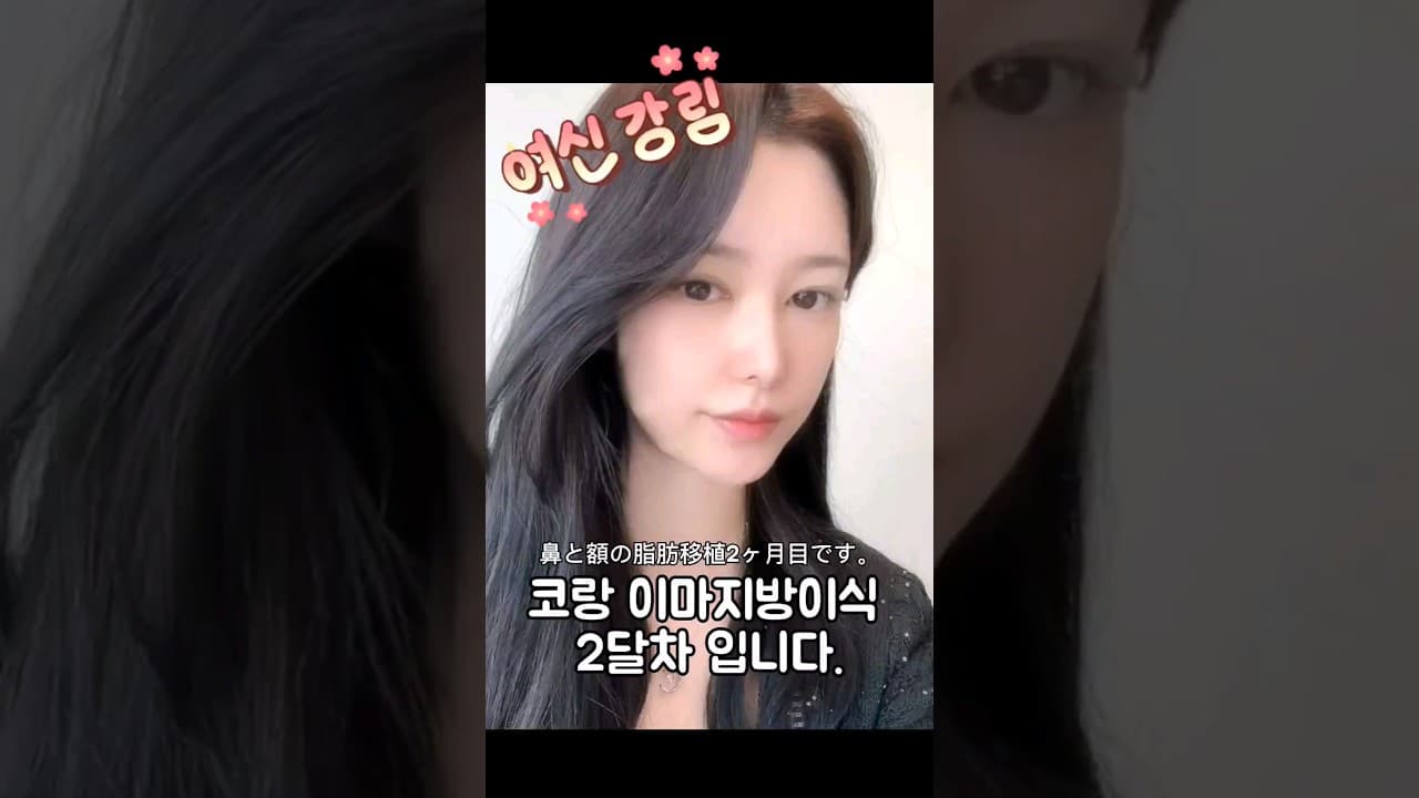 코수술 이마지방이식 수술 2달차 실제후기