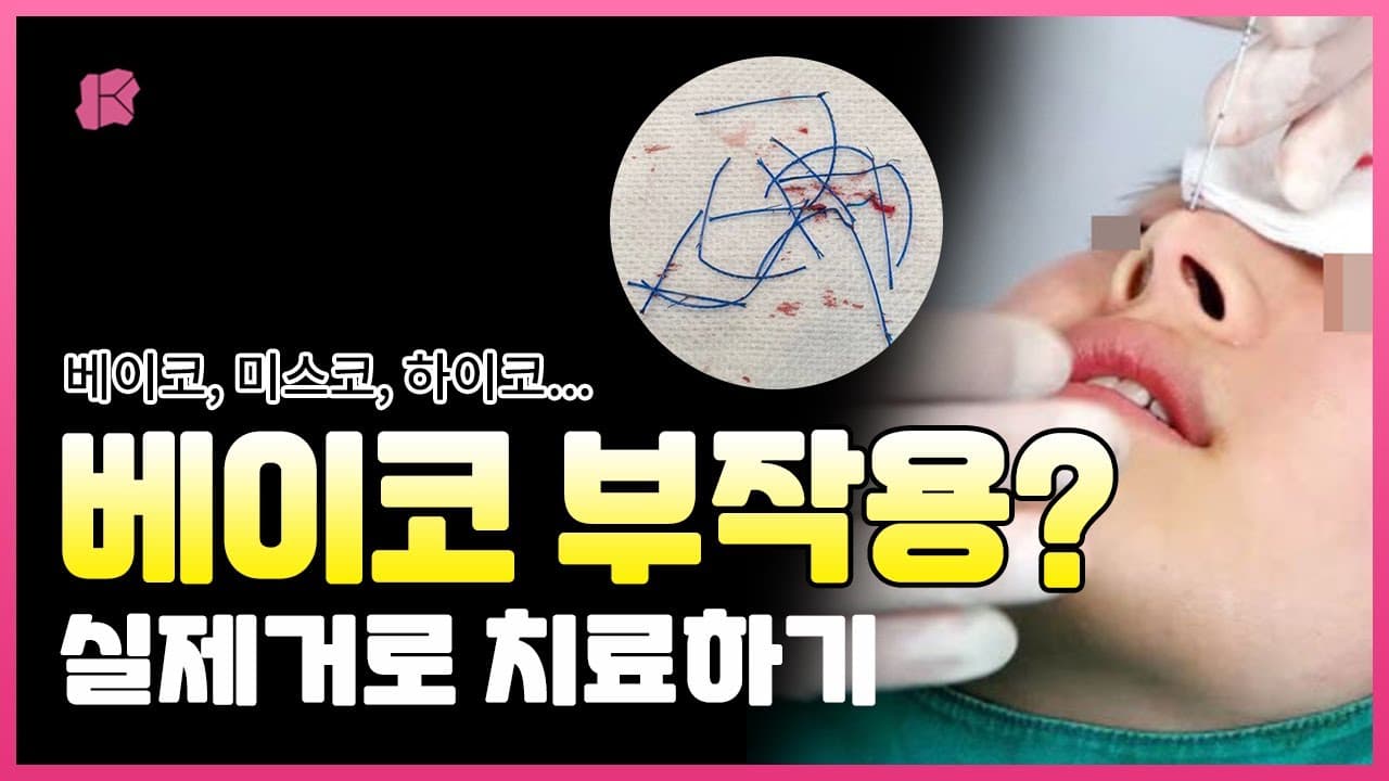 베이코 미스코 하이코 코시술 꼭 제거해야 할까요? | 코시술부작용 이물질 실제거