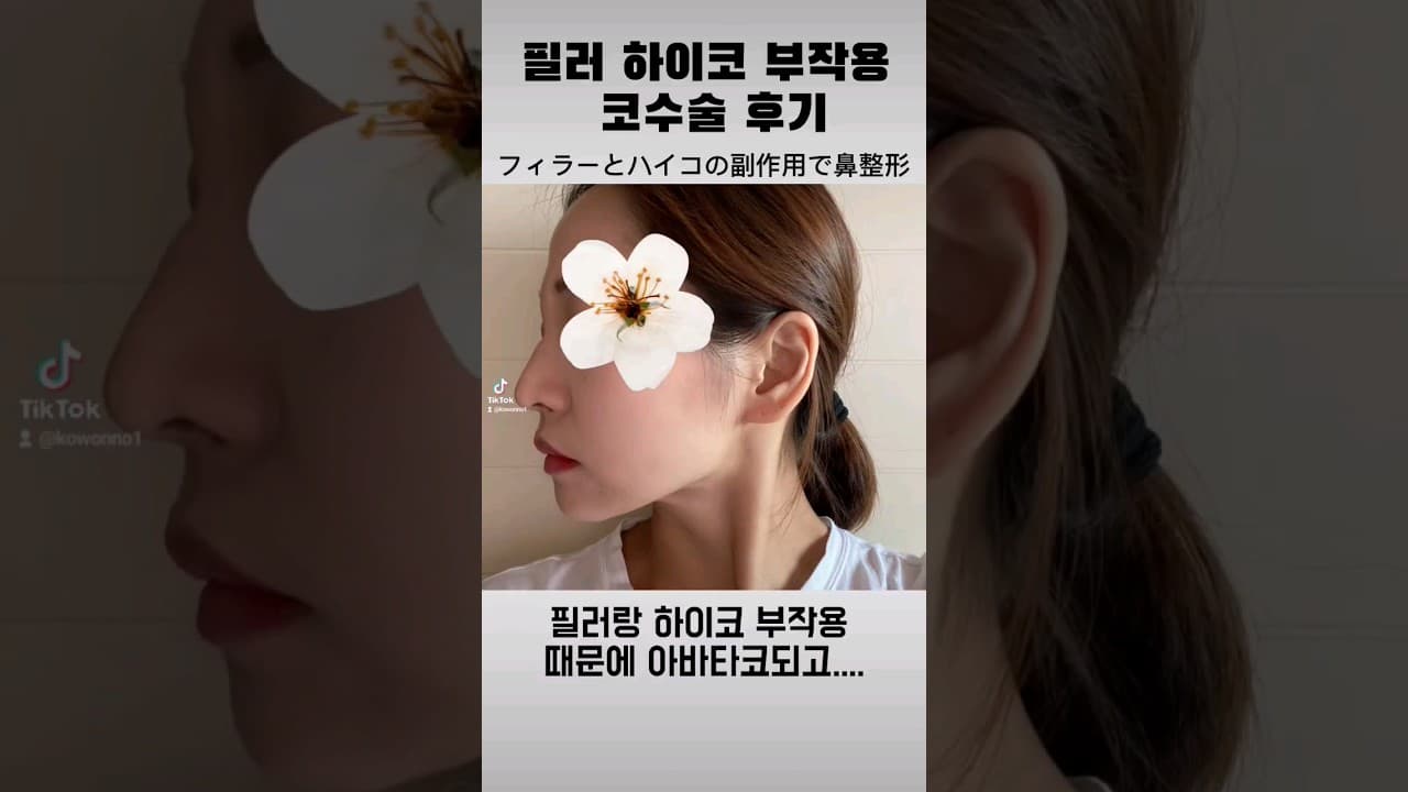 시술VS코수술 고민되시나요? 필러 하이코 부작용 때문에 코수술했습니다. (울퉁불퉁 아바타코)鼻プチ整形VS鼻整形、悩む！フィラーとハイコの副作用で鼻整形しました。(ゴツゴツしたアバター鼻)