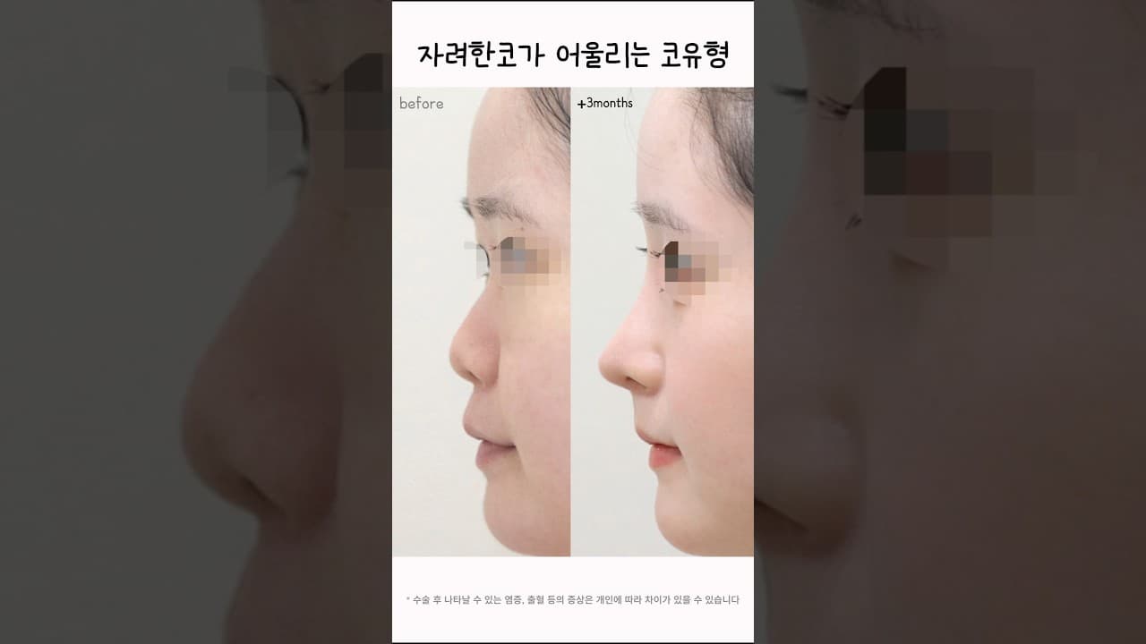 낮은코 비순각 교정으로 입매까지 예뻐지기 | 자가늑연골 코성형 전후
