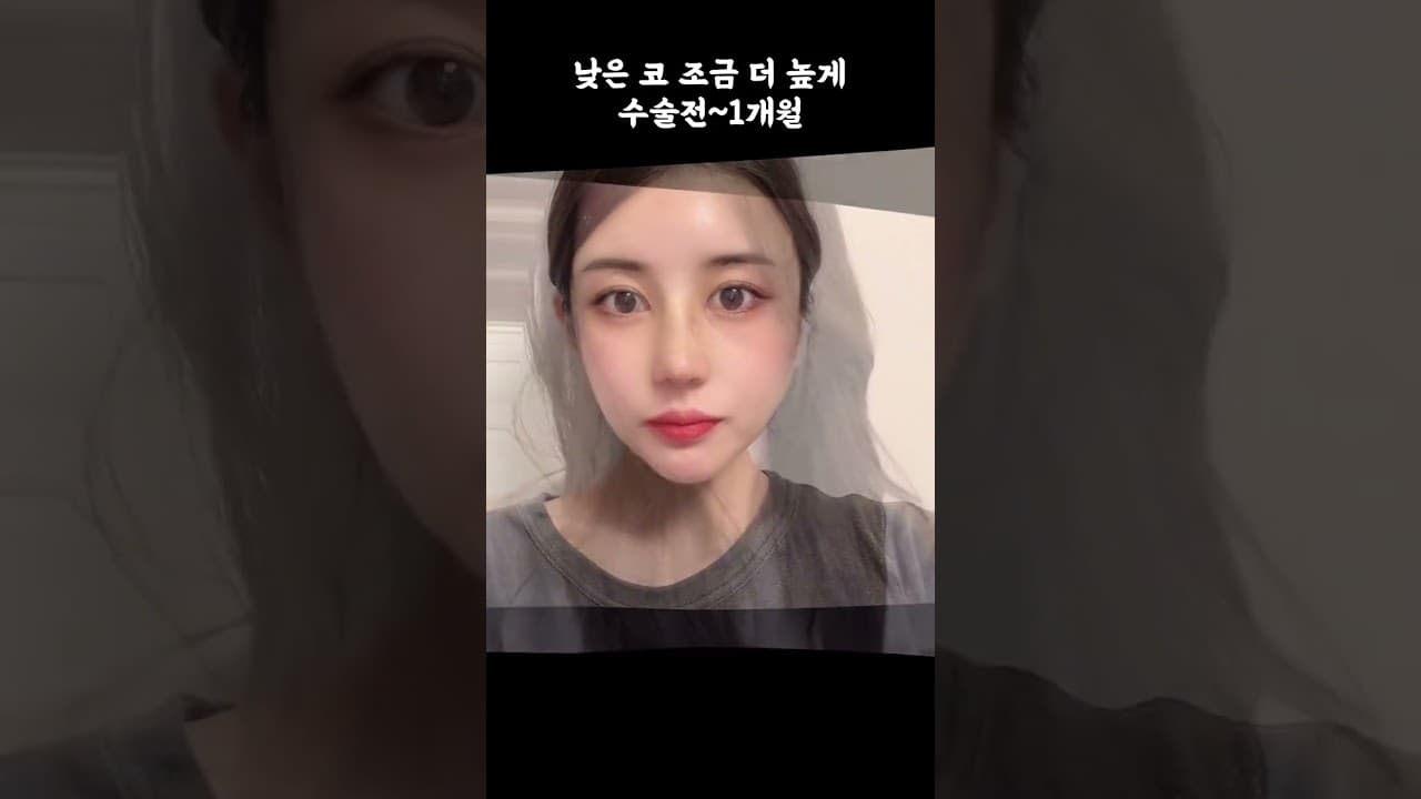 낮은코를 좀 더 높게! 멀어보이는 눈사이 코성형으로 개선!