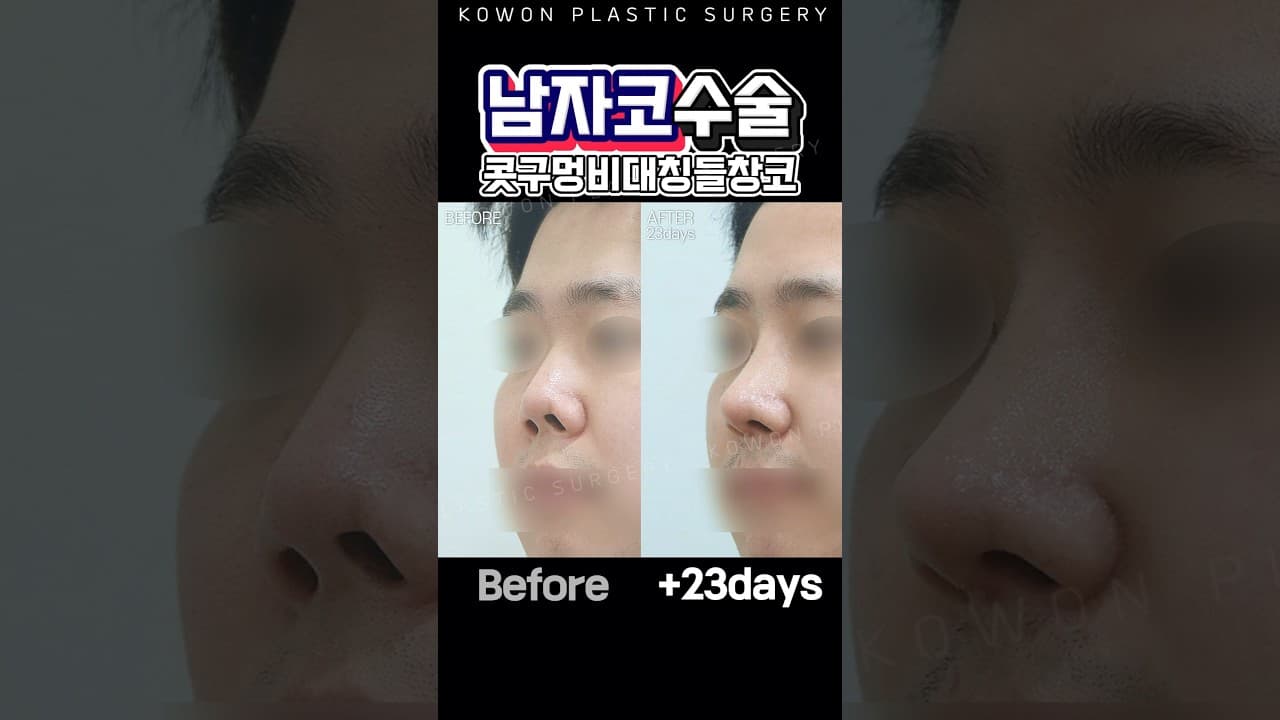 남자코수술 들창코느낌 없어지면??