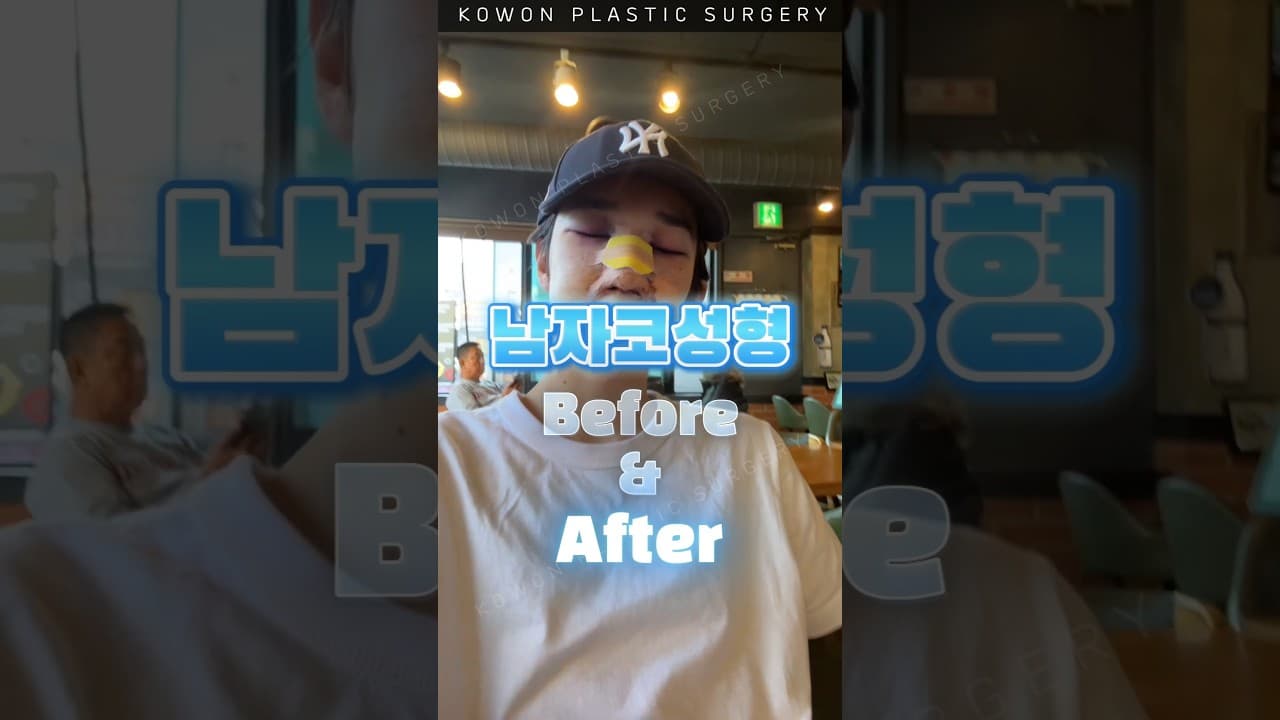 남자코수술 Before & After