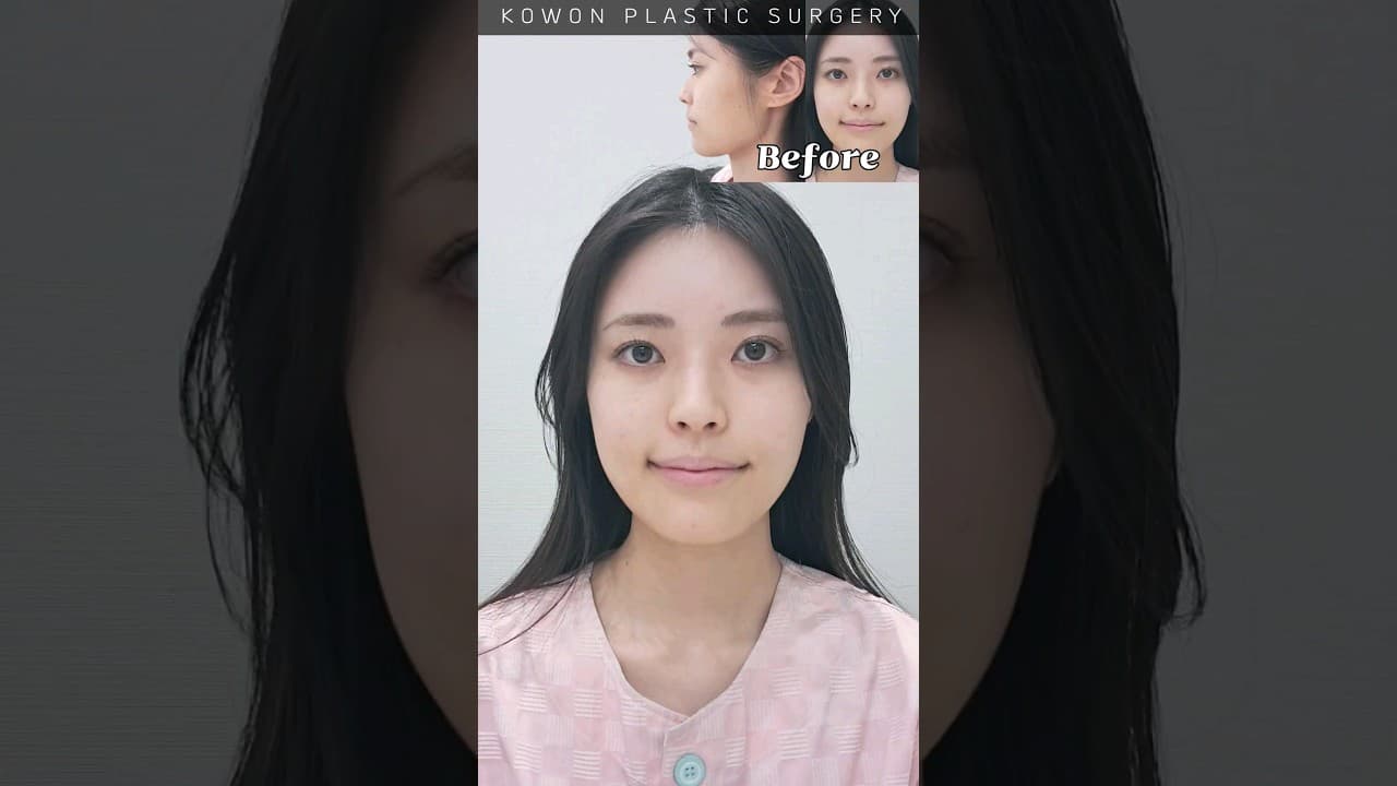 매부리코 낮은코 교정 전 후 (수술직후 & 코부목제거직후 같이보기)