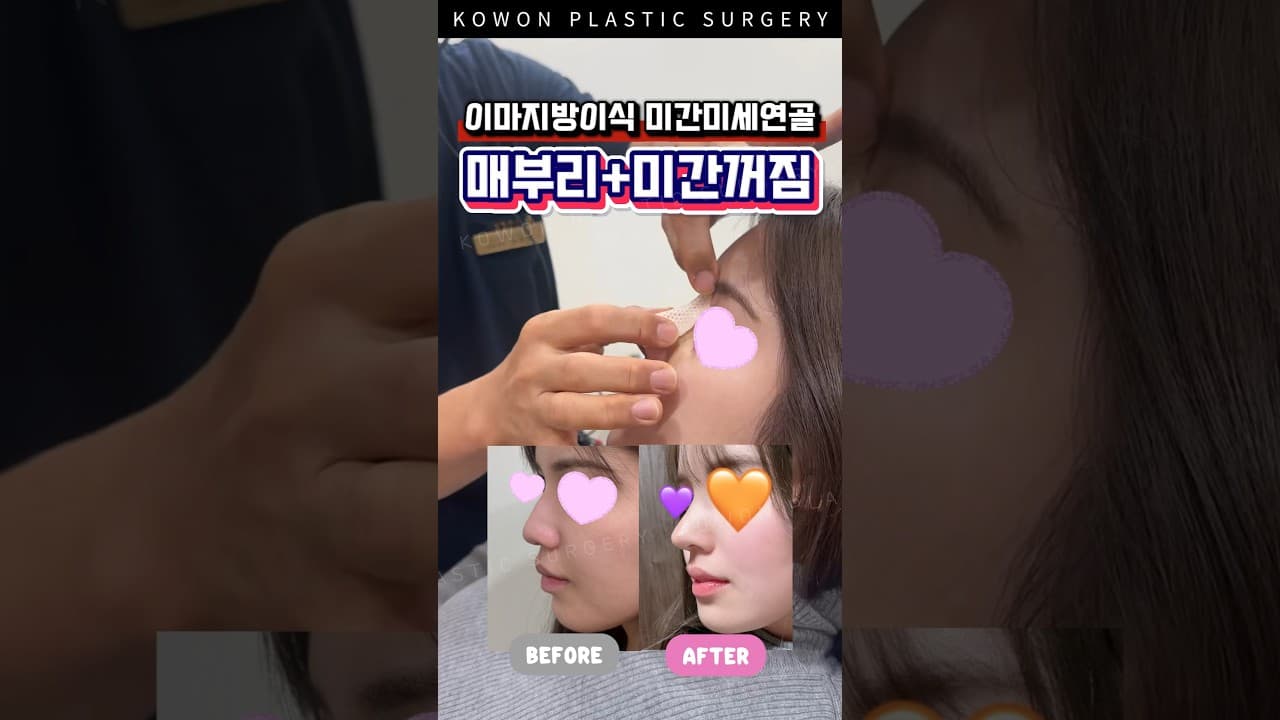 매부리코 + 이마라인 함께 교정하면?