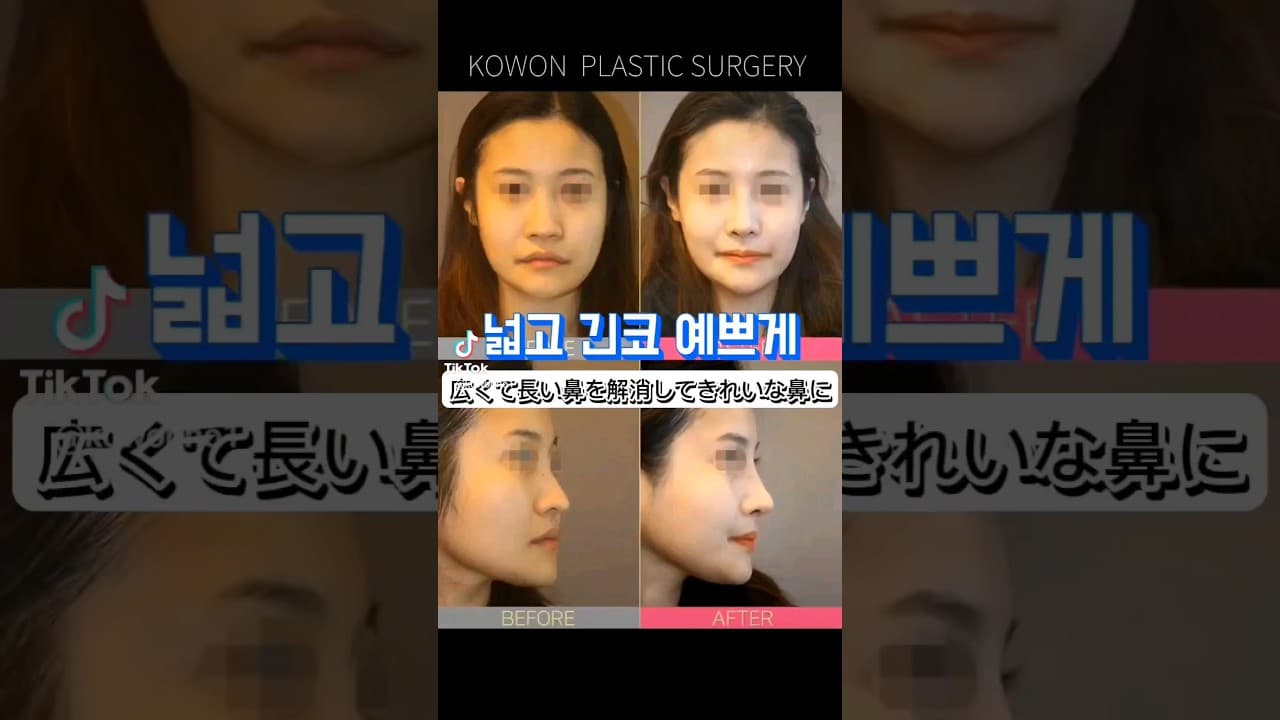 코원성형외과 | 넓고 긴코 예쁘게KOWON plastic surgery | Before and after the nose job(Long Nose)