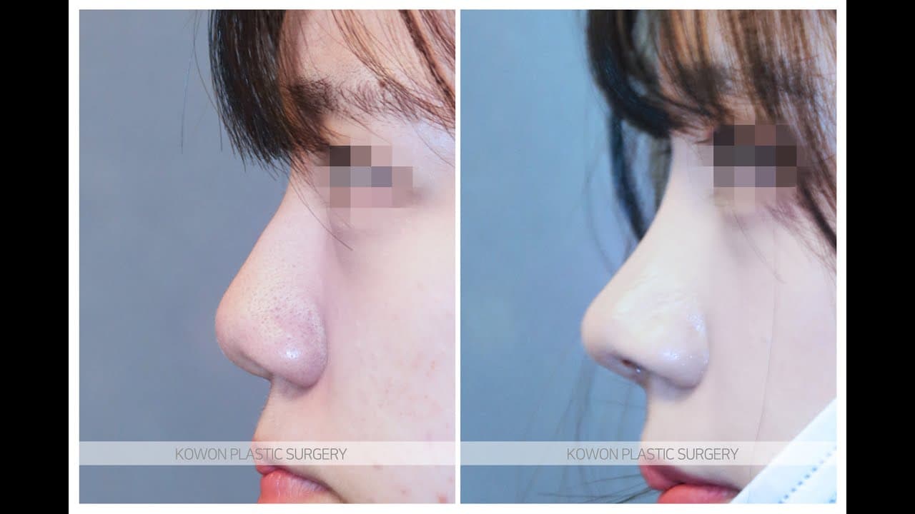 코원성형외과 코 성형 ★Before & After★