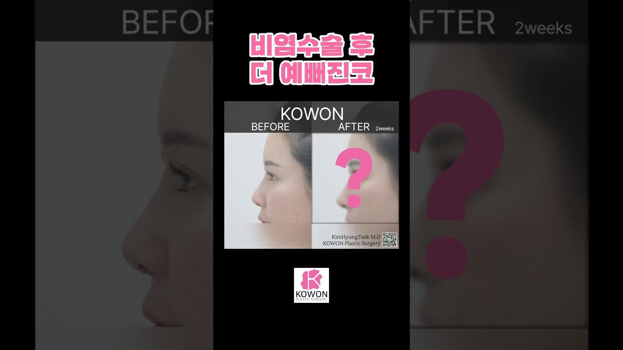 비염수술하고 코도예뻐지고