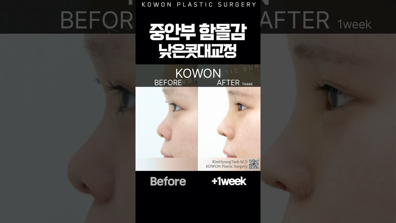 중안부 함몰감 고민? 낮은 콧대 교정으로 개선