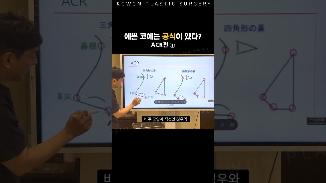 예쁜 코에는 공식이 있다? 콧날개와 비주 1~2mm의 차이 (ACR) 1