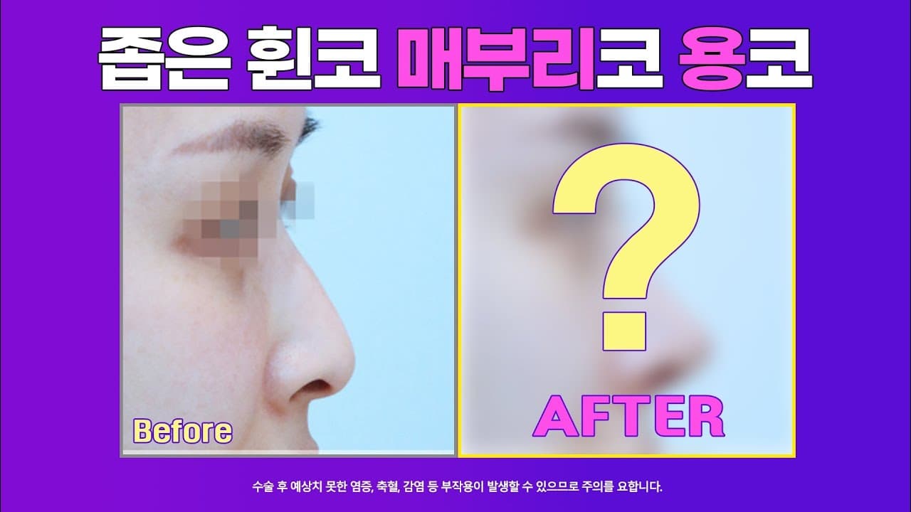 좁고 휘어있는 매부리코 용코 교정 수술 2주 전 후