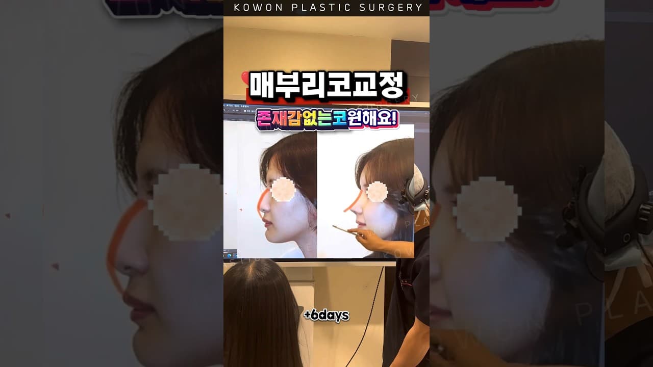 매부리코 교정, 존재감 없는 코로?