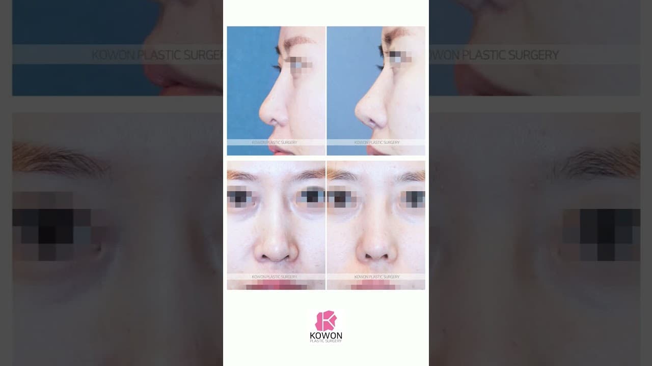코원 매부리코 긴코 교정 BEFORE&AFTER #beforeandafter #코원성형외과