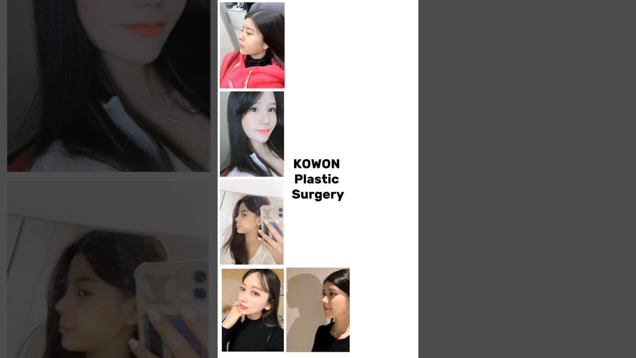 코성형 NO.1 코원성형외과김형택 대표원장이 직접 답변해드립니다. 코성형관련 궁금증 댓글달아주세요🥰(낮은코, 매부리코, 복코, 들창코, 코재수술)