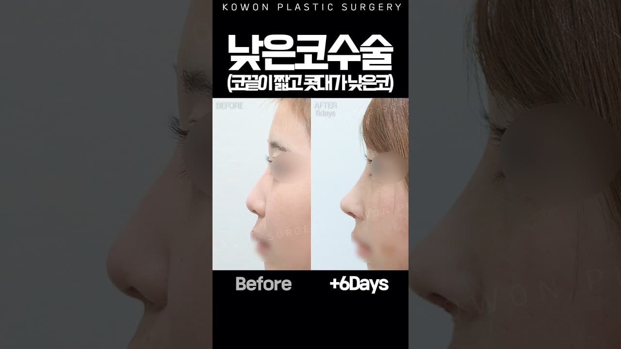 입이 튀어나와 보였던 진짜 원인은 코?!