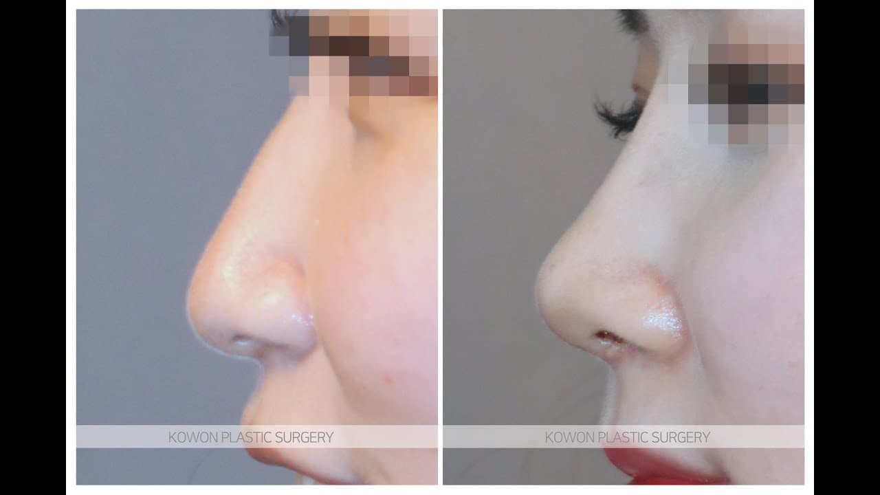 코원성형외과 코 성형 ★Before & After★