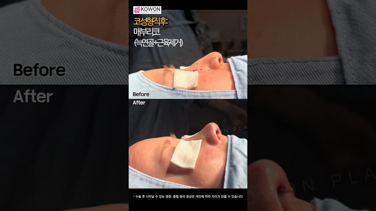 매부리코·화살코, 자가늑연골 코성형 직후 변화 공개