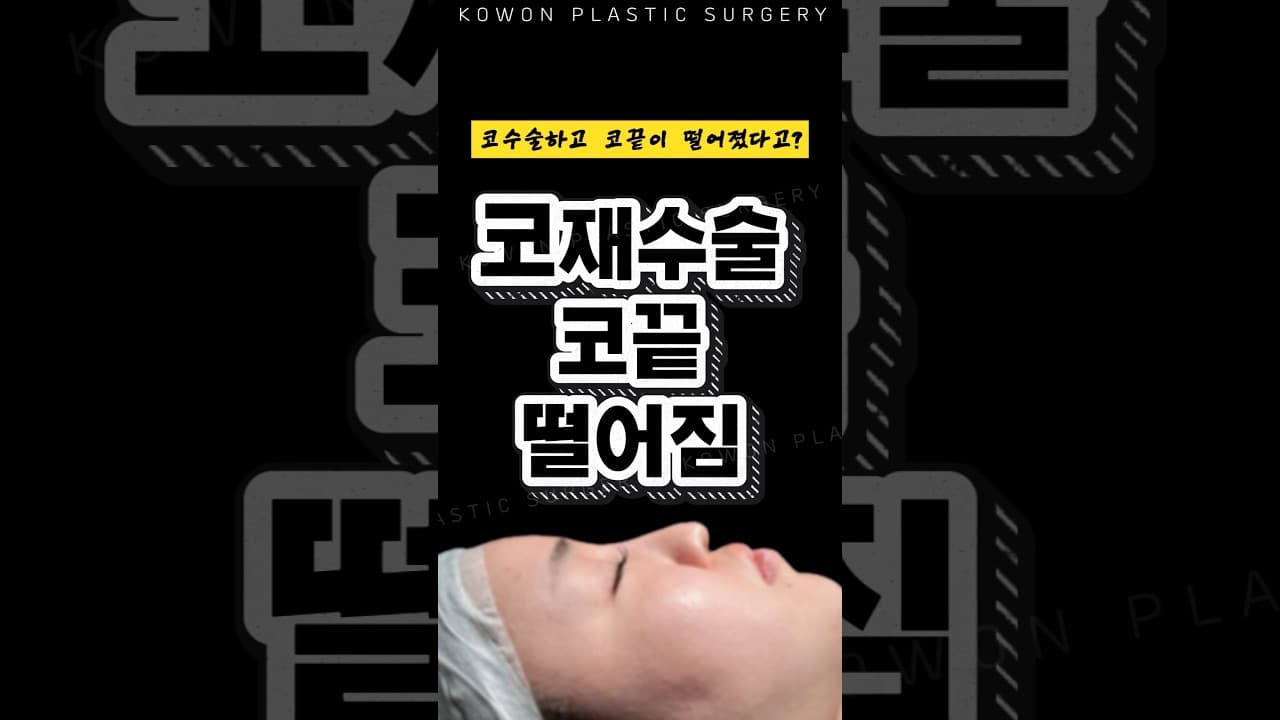 코수술하고도 떨어져 버린 코끝 #코재수술 #코원성형외과