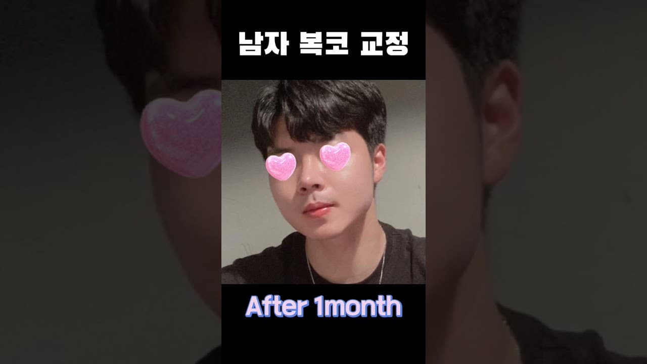 남자 복코 수술 후기 | 짧고 낮고 작은 복코가 고민이였어요 (男鼻整形 団子鼻矯正手術前後 | 鼻が短くて低くて広い団子鼻が気になって手術しました！)