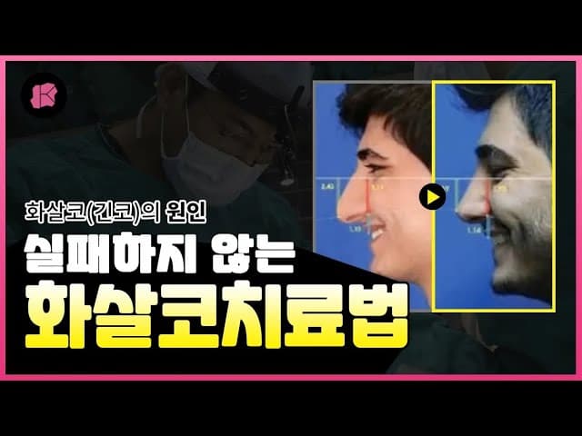 화살코 교정 실패하지 않는 법! 알기 쉽게 설명해드립니다👃
