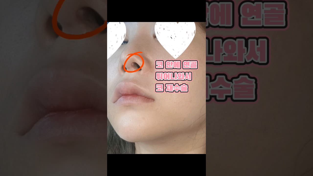 코성형 2주차 후기 | 코 안에 연골 튀어나와서 코 재수술 했어요