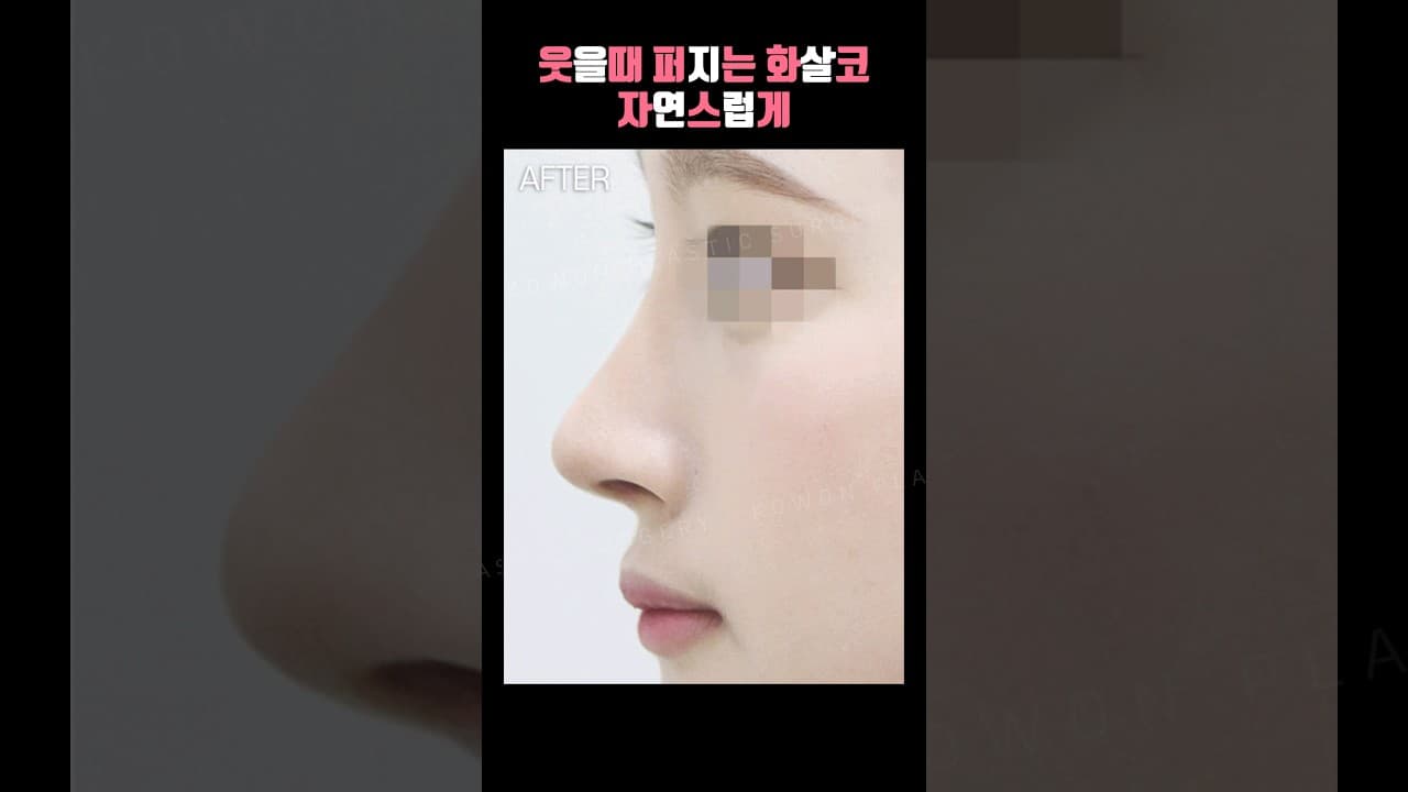 웃을때 퍼지는 화살코 자연스럽게 코원에서 교정
