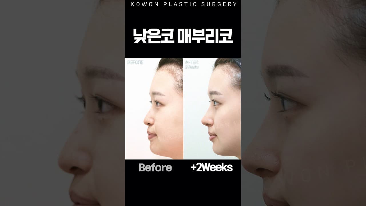 매부리코 + 낮은코끝, 동시에 수술했더니?